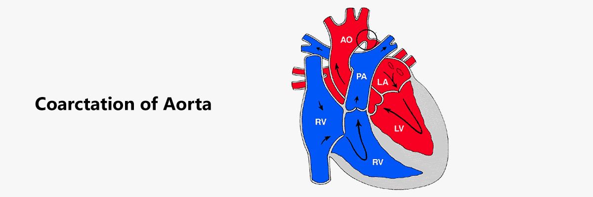 Лечение коарктации аорты