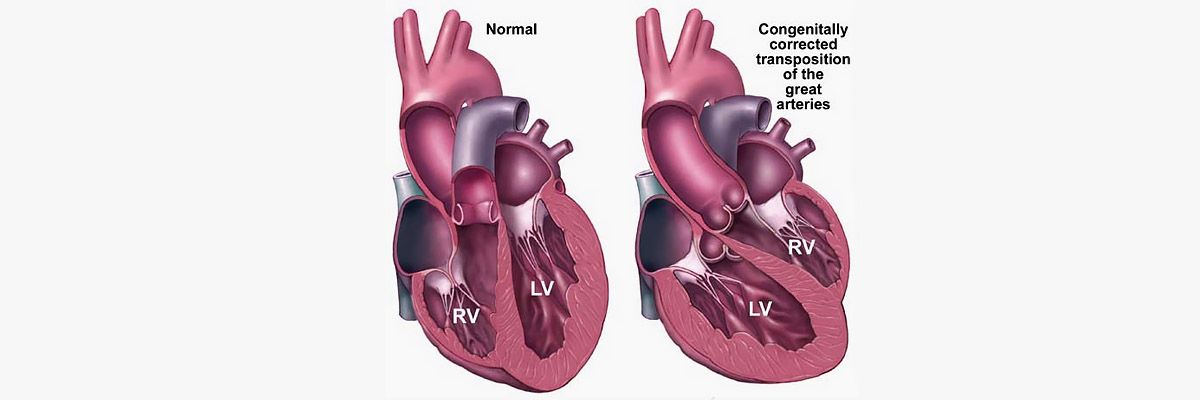 Устранение транспозиции магистральных сосудов